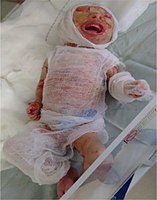 Младенец с ихтиозом Арлекина, покрытый стерильной марлей