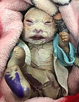 Младенец с ихтиозом Арлекина