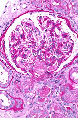 Микрофотография биоптата почки при острой тромботической микроангиопатии, вызванной ДВС-синдромом. Тромб находится в воротах клубочков (центр изображения).