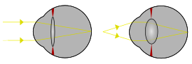 Пример различной рефракции глаз