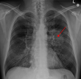 Рентгенограмма грудной клетки, демонстрирующая опухоль в лёгких