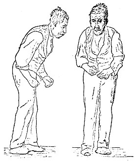 Пациент с болезнью Паркинсона. Рисунок из руководства 1886 года Уильяма Говерса