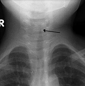 Симптом «остро заточенного карандаша» на рентгенограмме гортани в прямой проекции.