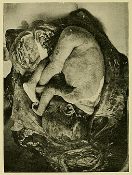 Женщина умершая от эклампсии (1911).