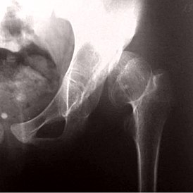Рентгенограмма, демонстрирующая развитие псевдоартроза при врожденном вывихе бедра