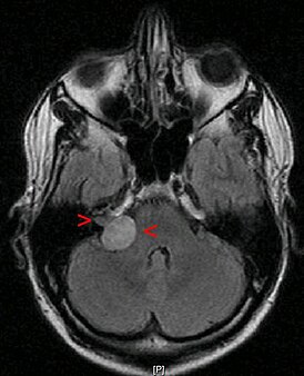 МРТ головного мозга. Невринома слухового нерва указана стрелками
