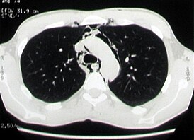 КТ-изображение: эмфизема средостения у больного со спонтанным пневмомедиастинумом