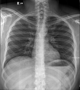 Рентген легких человека