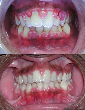 Тяжелая форма гингивита до (вверху) и после (внизу) тщательной хирургической обработки раны зубов и прилегающих тканей десен