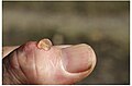Гигрома на ногтевой фаланге пальца руки