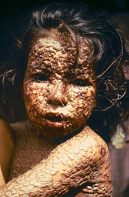 Девочка из Бангладеш, больная натуральной оспой (1973 год). О полном уничтожении оспы в Бангладеш было объявлено в декабре 1977 года, когда Всемирная организация здравоохранения официально подтвердила этот факт