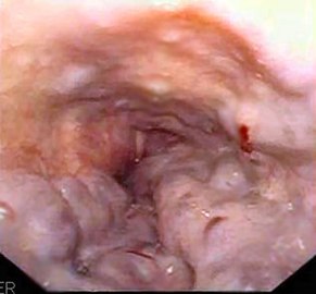 Эндоскопия пищевода пациента с варикозным расширением вен пищевода