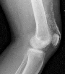 Рентгенограмма коленного сустава пациента с дерматомиозитом.