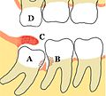 Некоторые проблемы, которые могут возникнуть или не возникнуть с третьими молярами: A Мезиоретинированный, частично прорезавшийся третий моляр нижней челюсти; B Кариес зубов и дефекты пародонтита, связанные как с третьими, так и со вторыми молярами, вызвано упаковкой пищевых продуктов и плохим доступом к методам гигиены полости рта; C Воспалённый капюшон, покрывающий частично прорезавшийся третий нижний моляр, со скоплением остатков пищи и бактерий под ним; D Верхний третий моляр перерос, разрывается из-за отсутствия контакта с противоположным зубом и может начать травматически окклюзию в крышечку над нижним третьим моляром. Зубы без сопротивления обычно острые, потому что они не притуплены другим зубом.