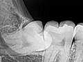 Рентгеновский снимок ретинированного нижнего правого зуба мудрости с горизонтальной ориентацией