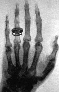 Рентгеновский снимок руки Кёлликера, сделанный Рентгеном 23 января 1896 года.