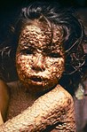 Девочка из Бангладеш с натуральной оспой