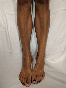 Потемнение кожи на ногах белого человека с болезнью Аддисона