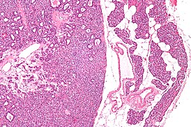 Микропрепарат: аденома паращитовидной железы слева, справа — неизменённая ткань паращитовидной железы.