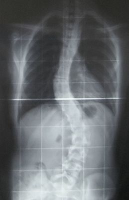 Рентгеновский снимок позвоночника пациента со сколиозом с левосторонним искривлением в поясничном отделе и правосторонним искривлением в грудном отделе позвоночника.