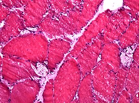 Биопсия мышечной ткани: на замороженном микропрепарате видны крупные вакуоли, характерные для болезни Помпе
