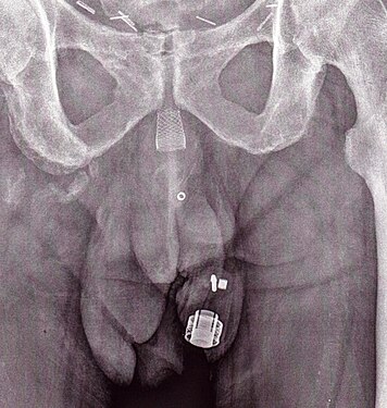 Рентгеновское изображение имплантированного ZSI 375. Устройство деактивировано — пружина сжимается ниже верхушки цилиндра. У пациента недержание мочи.