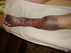 Нога пациента с посстромбофлебитическим синдромом и трофическими язвами