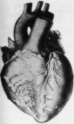 Узелковый периартериит: Макроскопические образцы сердца с обильной жировой тканью и узловыми утолщениями коронарных сосудов