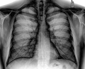 Обработанная цифровая рентгенограмма грудной клетки (лёгочные поля в позитивном изображении, с повышенной контрастностью).