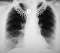 Некачественная рентгенограмма грудной клетки.