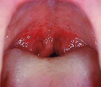 Широко открытый рот, демонстрирующий горло Заметны петехеи и маленькие красные пятна на мягком нёбе. Данное проявление является редким, но очень специфичным для стрептококковой инфекции[9].