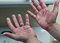Руки пациента примерно через десять дней химиотерапии капецитабином с признаками эритемы средней тяжести