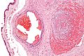 Гистологический препарат тромба в сосуде плаценты при тромботической васкулопатии плода[en]